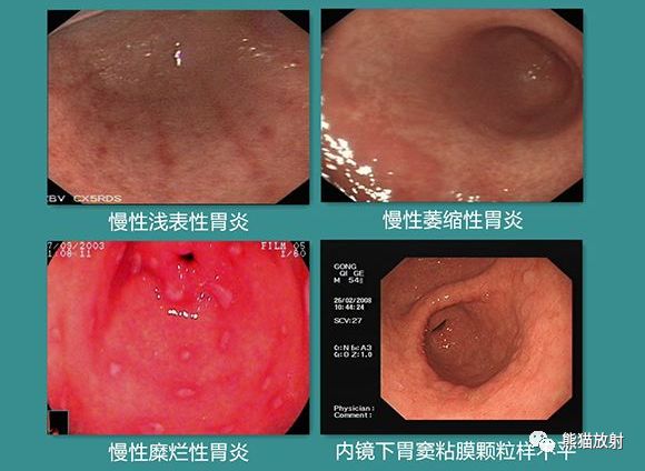 慢性胃炎患者的饮食选择建议